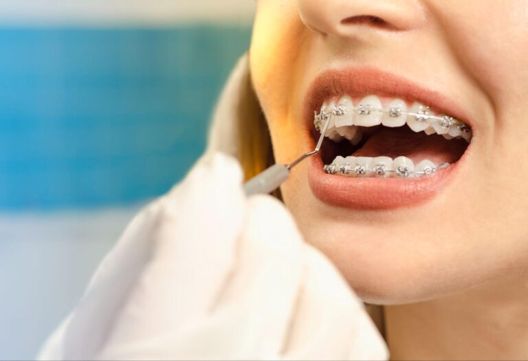How Do Braces Move Teeth? Dr. Lili & Associates