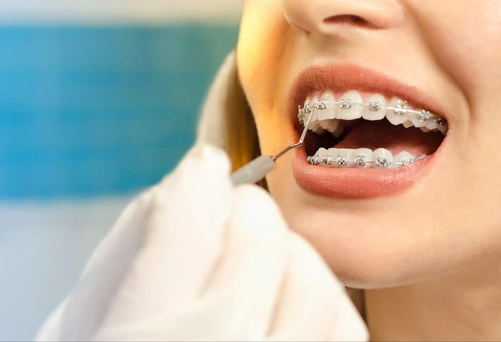 How Do Braces Move Teeth?